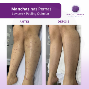 manchas-corporais